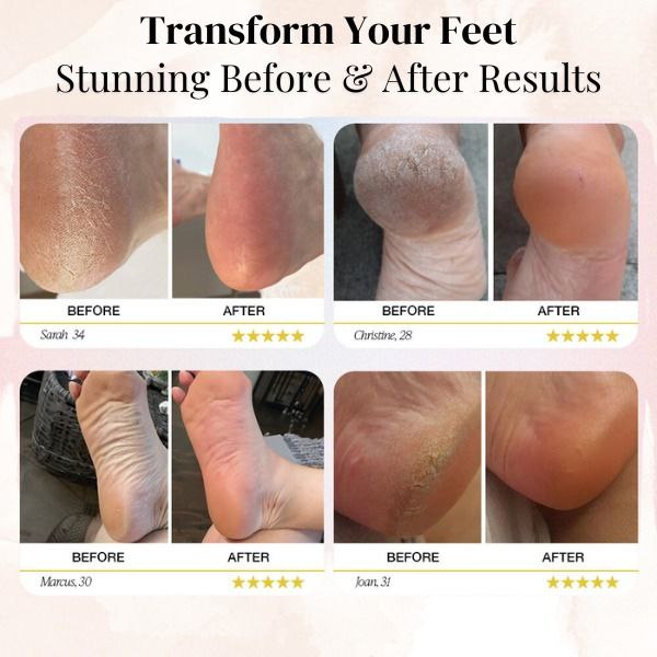 StepGlam™: The ultimate electric callus remover